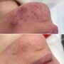 Акне лечить не просто